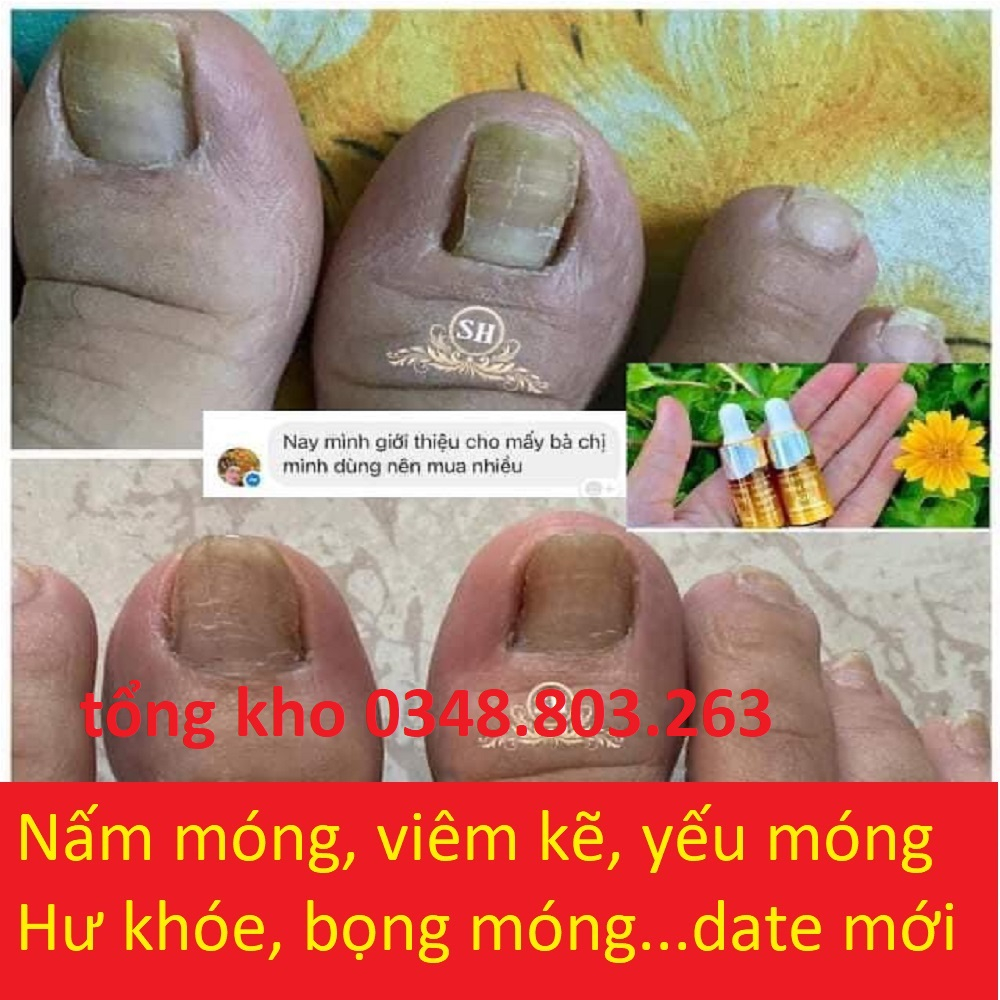 Serum nấm móng hỗ trợ đtri nấm móng tay chân