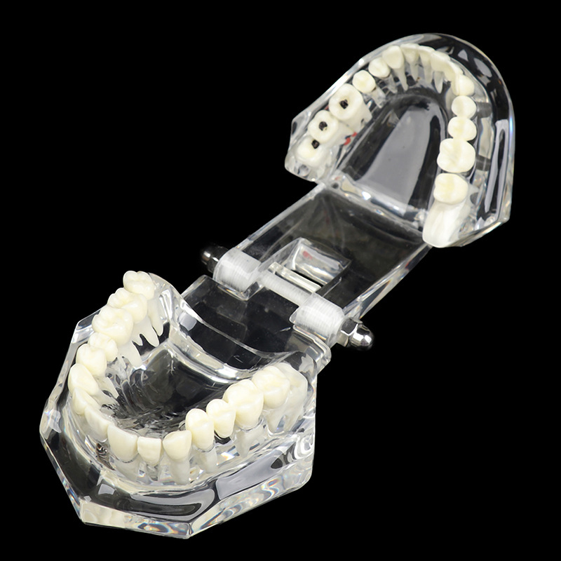 Mẫu hàm tư vấn nha khoa, mô hình tư vấn sâu răng, cắm implant, sâu răng DN42