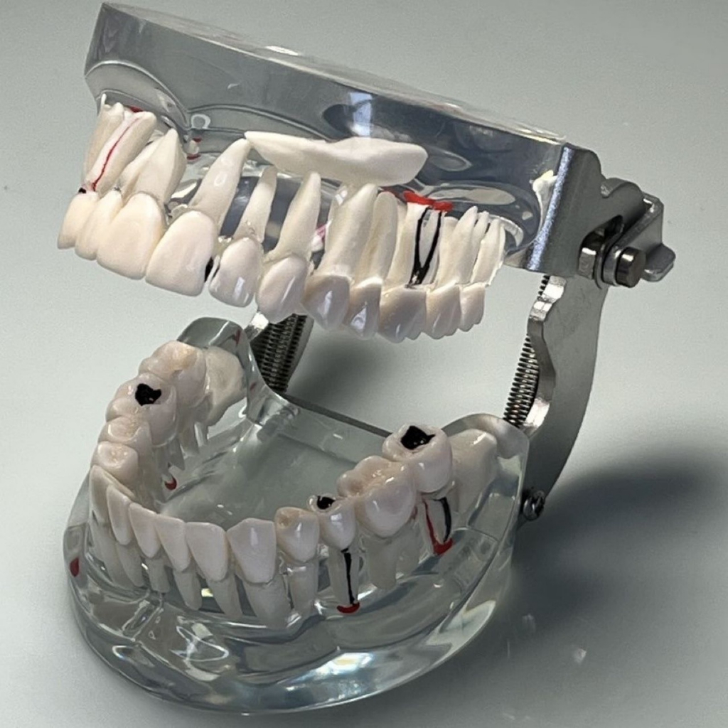 Mẫu hàm tư vấn nha khoa, mô hình tư vấn sâu răng, cắm implant, sâu răng DN42