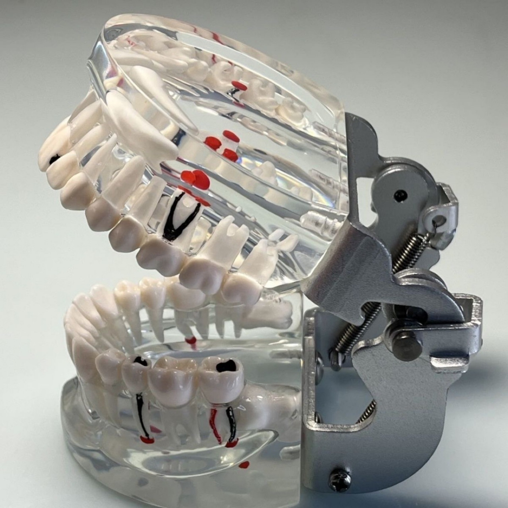 Mẫu hàm tư vấn nha khoa, mô hình tư vấn sâu răng, cắm implant, sâu răng DN42