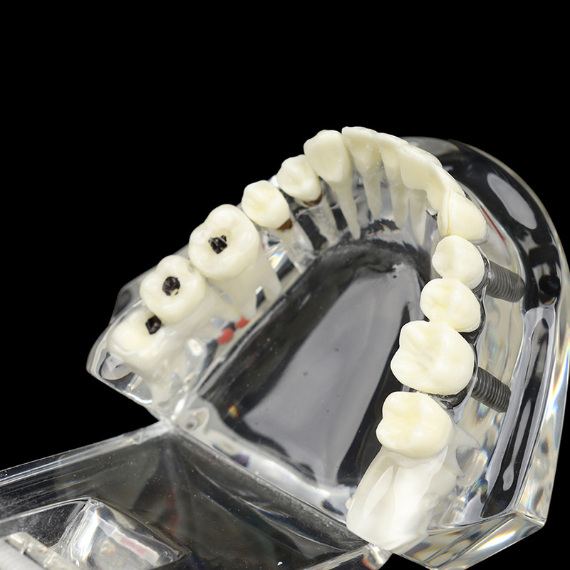 Mẫu hàm tư vấn nha khoa, mô hình tư vấn sâu răng, cắm implant, sâu răng DN42