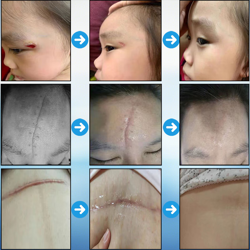 Kem Sẹo Kem xóa Sẹo dermatix Sửa chữa sẹo Kem tẩy tế sẹo Sẹo tăng sinh Vết sẹo phẫu thuật Chuyên