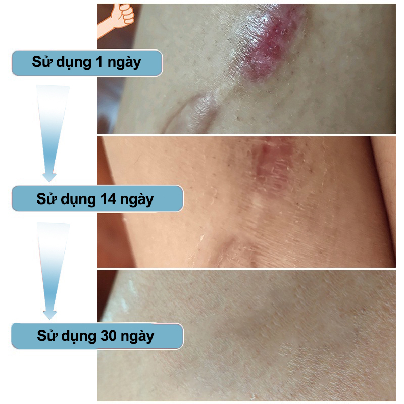 Kem Sẹo Kem xóa Sẹo dermatix Sửa chữa sẹo Kem tẩy tế sẹo Sẹo tăng sinh Vết sẹo phẫu thuật Chuyên