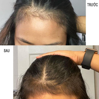 Xịt Bưởi Kích Mọc Tóc - Xịt Dưỡng Mọc Tóc 100ml
