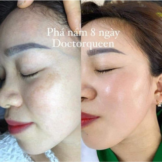 K2 TINH CHẤT ỨC CHẾ NÁM ( số 2 trong bộ phá nám 8 ngày)