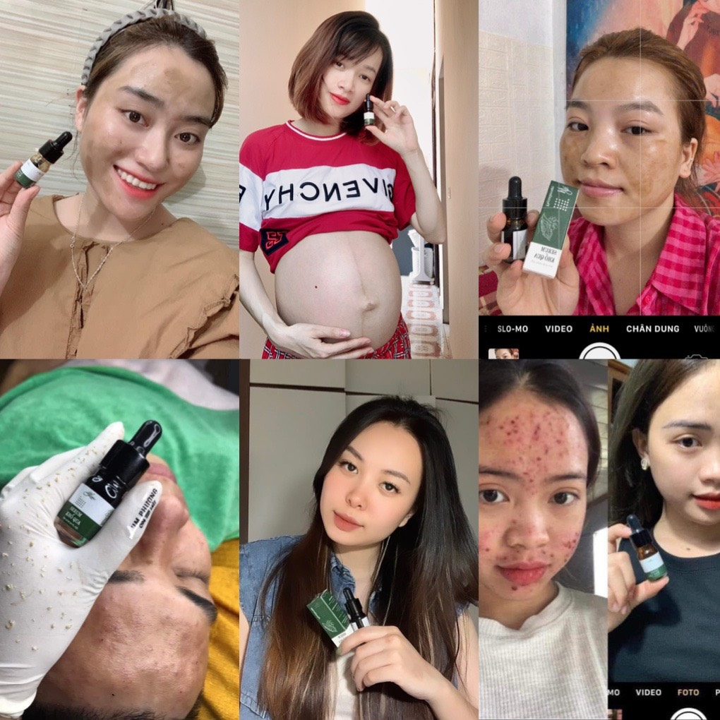 Serrum ngừa mụn , giảm thâm , giúp trắng sáng da LIM