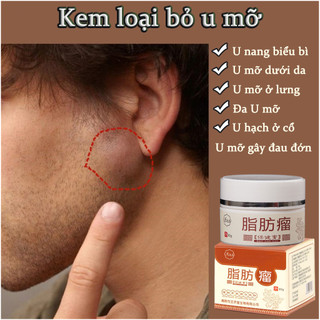 Kem bôi u bướu mỡ loại bỏ 30g Loại bỏ u mỡ hiệu quả Loại bỏ u mỡ không đau không bao giờ tái phát