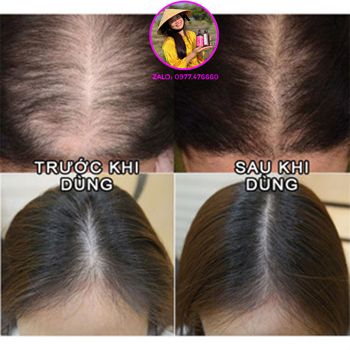 Dầu gội thảo dược HB . Sạch gàu, kích thích mọc tóc