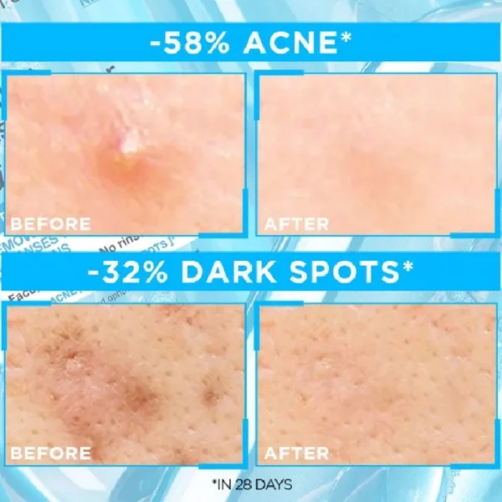 Gel Rửa Mặt Sạch Thoáng Dịu Nhẹ Cho Da Dầu Mụn Garnier Bright Complete Anti-Acne Cleansing Gel 120ml