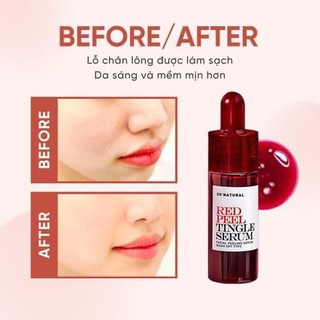 𝑹𝒆𝒅 𝑷𝒆𝒆𝒍 𝑻𝒊𝒏𝒈𝒍𝒆 𝑺𝒆𝒓𝒖𝒎 11ml mẫu mới