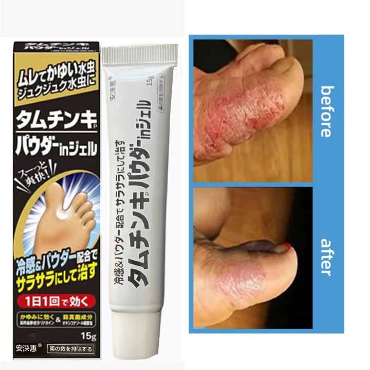 Nhật Bản Kem Khử mùi hôi chân mồ hôi chân và thối chân dạng Chàm Chống Ngứa Hiệu Quả Kem Dưỡng Da Chân Chống Nấm Và Ngứ