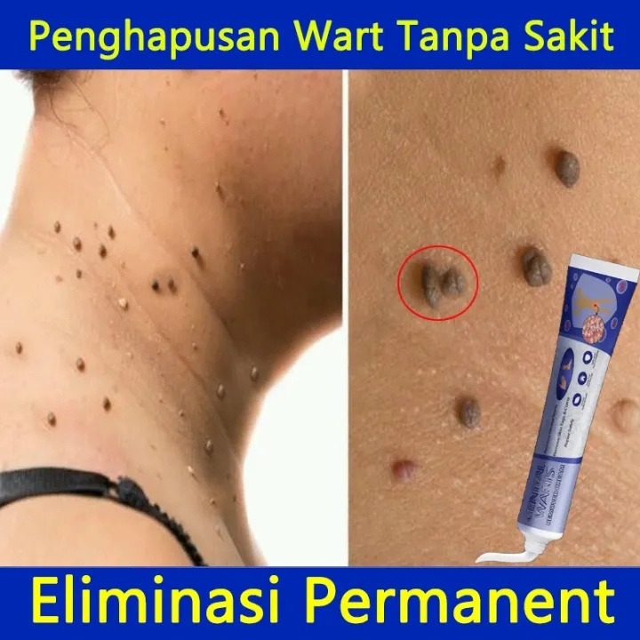 South Moon Wart Remoal Cream Tẩy nốt ruồi đánh bật các loại mụn trên cơ thể xóa mụn ruồi trên mặt, tàn nhang, mụn cóc, m