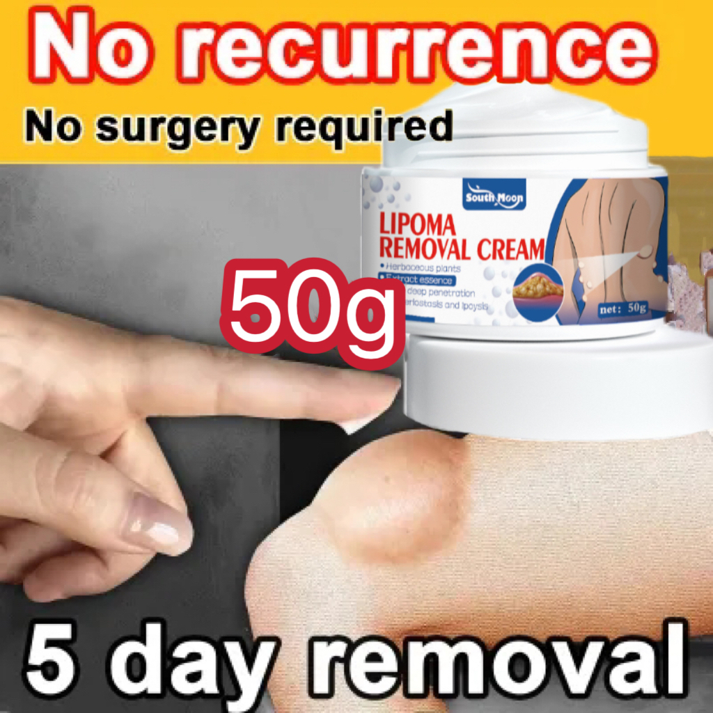 Kem mềm u mỡ, xử lý hạt mỡ, loại bỏ nhiều khối u mỡ tuyến giáp và u mỡ dưới da 50g