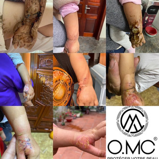 Mặt nạ thải độc omc