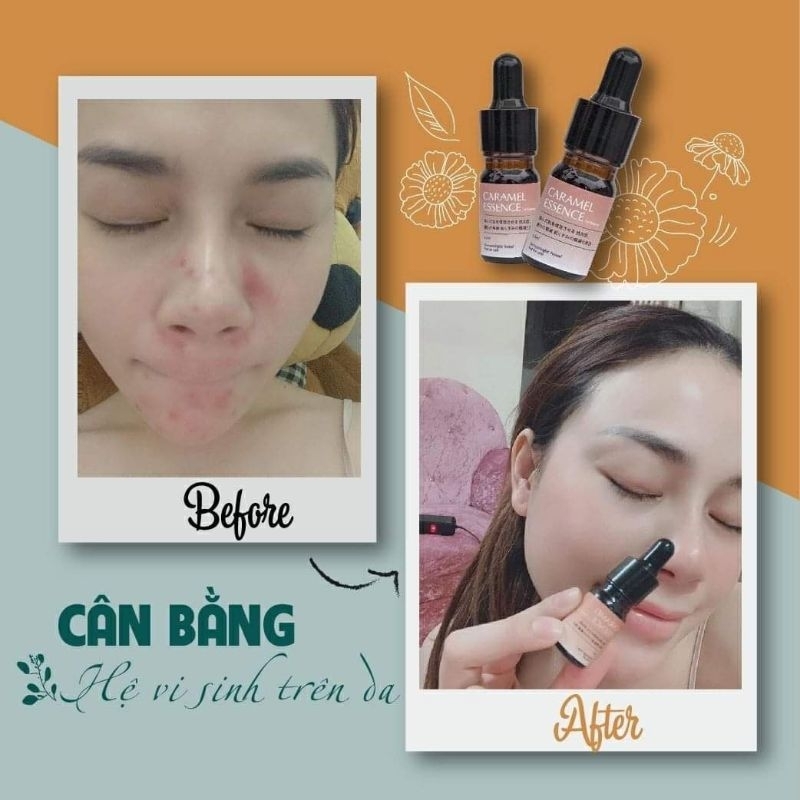 [Tang cây nặn mụn l1) Serum Caramel Essence Nhập khẩu Chính Hãng Nhật xoá mụn detox mờ thâ