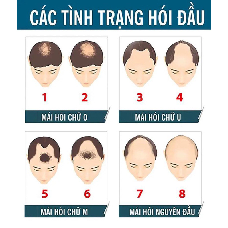 Tóc giả nam che hói làm từ tóc thật màu đen tự nhiên