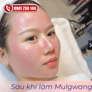Cấy căng bóng mulgwang x5( Nâu)