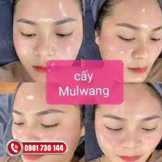 Cấy căng bóng mulgwang x5( Nâu)
