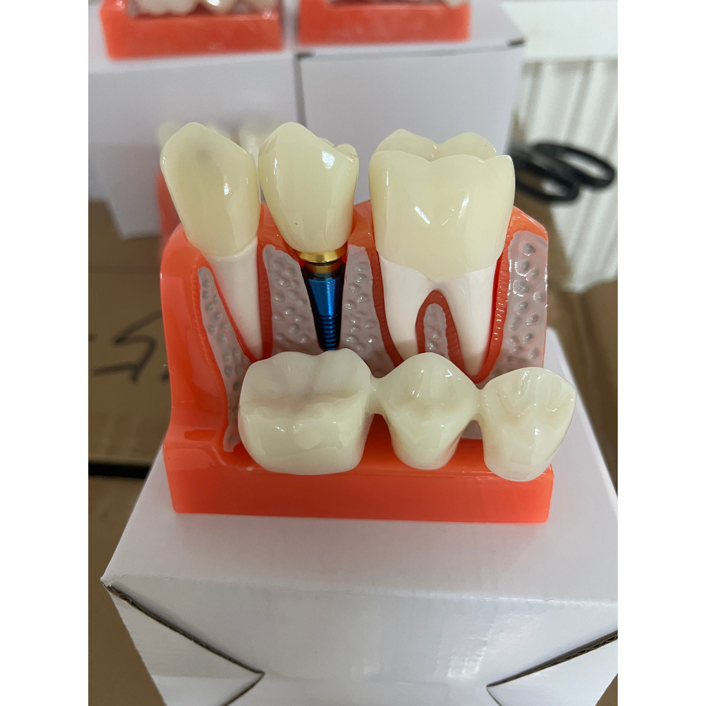 Mẫu hàm tư vấn nha khoa, mô hình tư vấn sâu răng, cắm implant, sâu răng