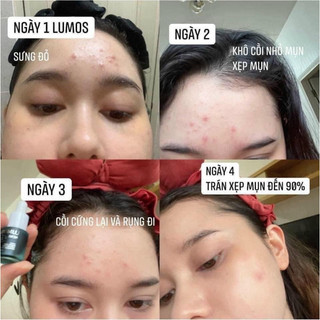 T.rị m.ụn Lumos ( nhập khẩu )