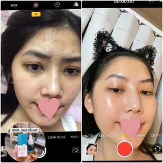 T.rị m.ụn Lumos ( nhập khẩu )