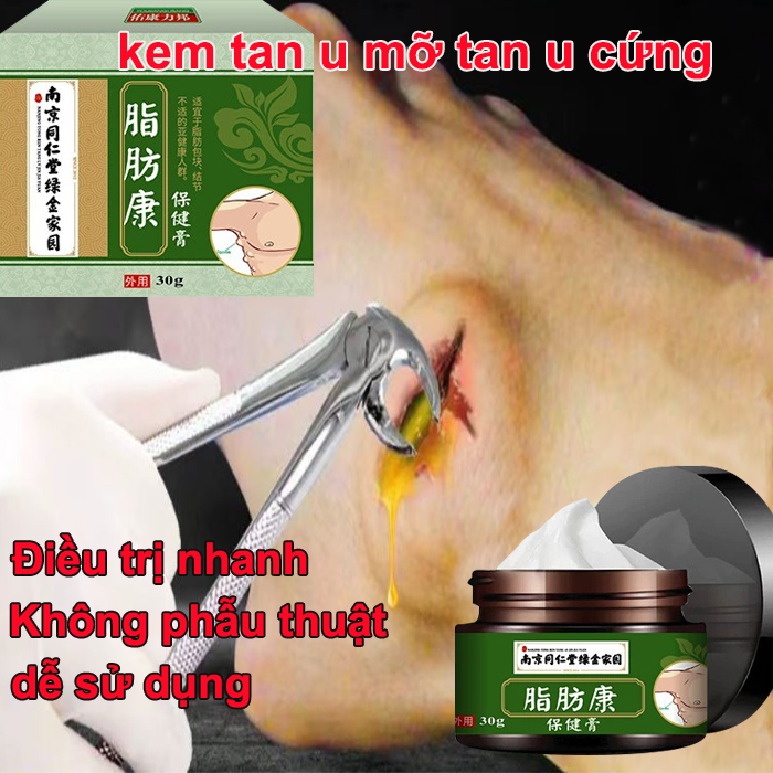 U mỡ Diệt trừ Kem Lipoma kem tan mỡ thảo dược thiên nhiên u nang da nhanh hòa tan 30g