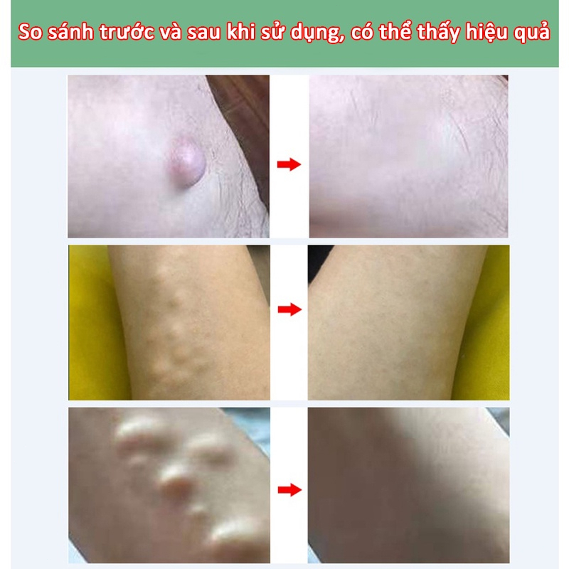 U mỡ Diệt trừ Kem Lipoma kem tan mỡ thảo dược thiên nhiên u nang da nhanh hòa tan 30g