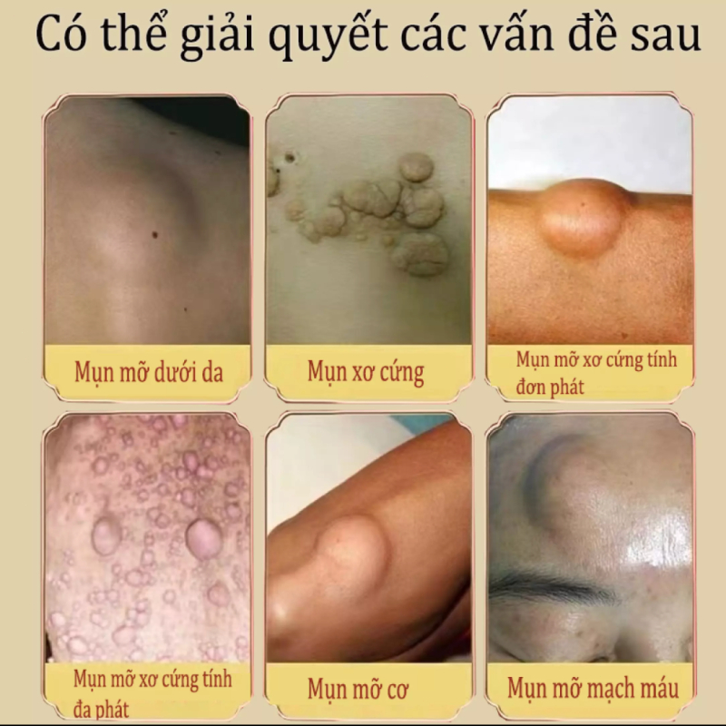 U mỡ Diệt trừ Kem Lipoma kem tan mỡ thảo dược thiên nhiên u nang da nhanh hòa tan 30g
