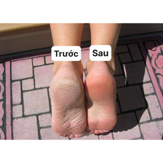 Kem bôi nứt gót chân Scholl