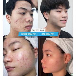 NGỌC SÂM [SERUM MỤN & MẶT NẠ] • Bộ Mini ✔️