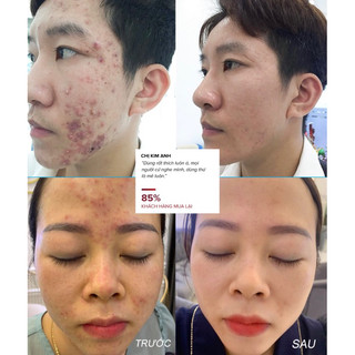 SERUM MỤN NGỌC SÂM [Mini] ✔️