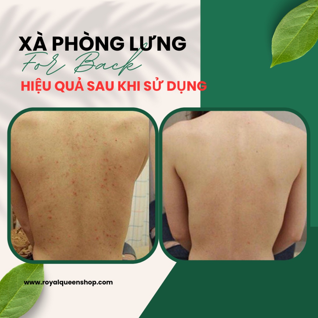 GIảm mụn lưng For back soap 💕 𝑭𝒓𝒆𝒆𝒔𝒉𝒊𝒑 💕 xà phòng ngừa thâm lưng Pelican số 1 Nhật Bản 135g