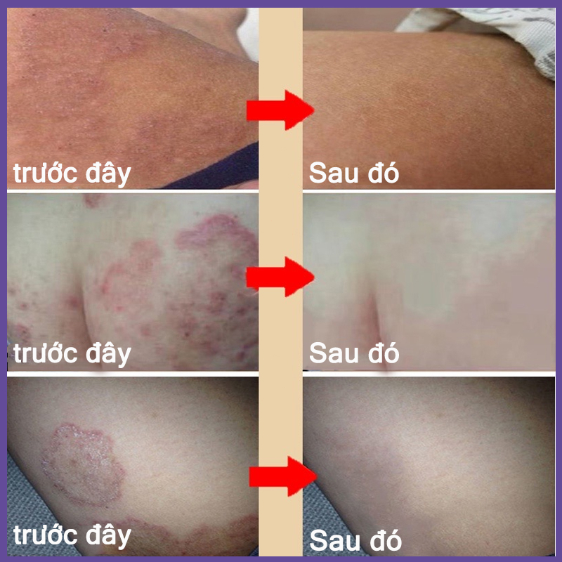 Chăm sóc vùng kín Kem  Kem giảm ngứa 30g Chống nấm chống ngứa Da sử dụng bên ngoài các bộ phận riêng tư có thể được sử