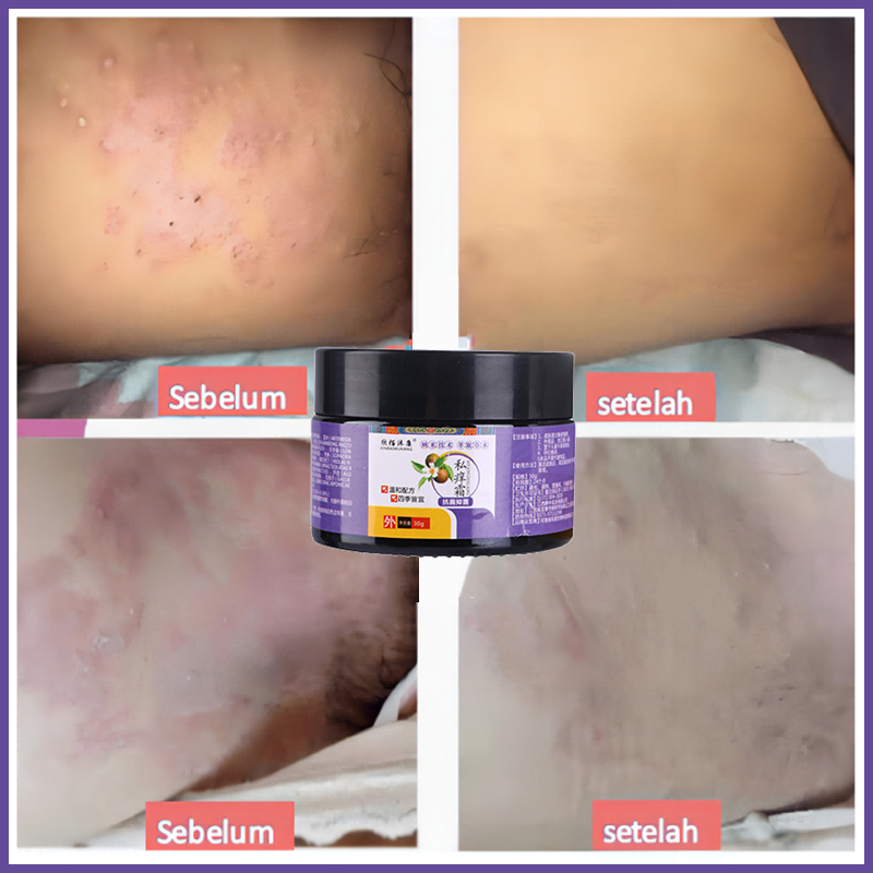 Chăm sóc vùng kín Kem  Kem giảm ngứa 30g Chống nấm chống ngứa Da sử dụng bên ngoài các bộ phận riêng tư có thể được sử