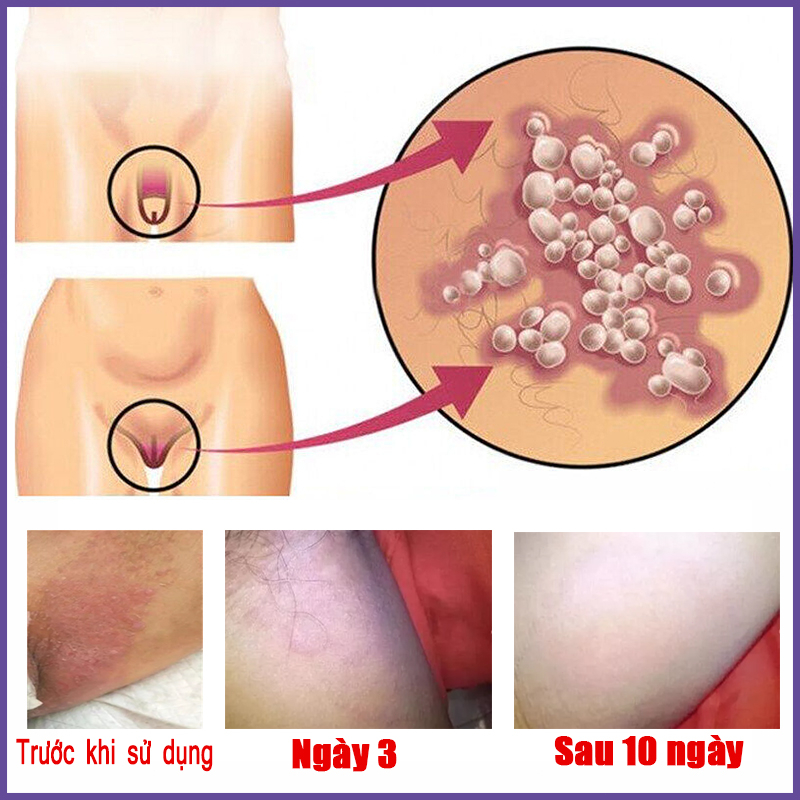 Chăm sóc vùng kín Kem  Kem giảm ngứa 30g Chống nấm chống ngứa Da sử dụng bên ngoài các bộ phận riêng tư có thể được sử