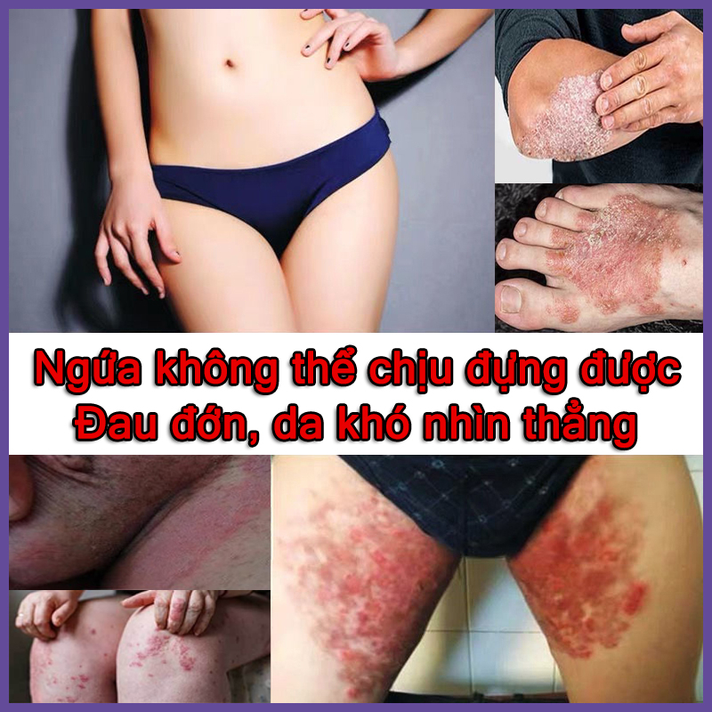 Chăm sóc vùng kín Kem  Kem giảm ngứa 30g Chống nấm chống ngứa Da sử dụng bên ngoài các bộ phận riêng tư có thể được sử