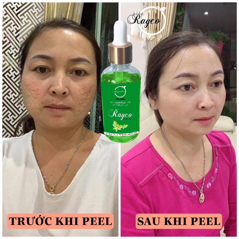 Peel Nám RAYCO Cao Cấp