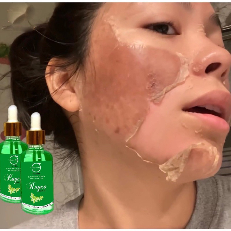 Peel Nám RAYCO Cao Cấp