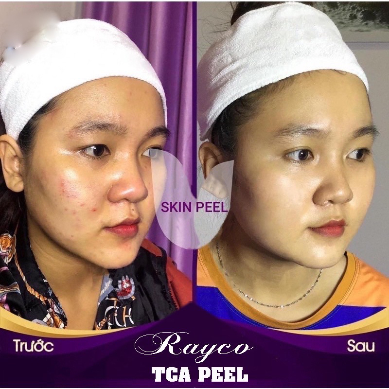 Peel Nám RAYCO Cao Cấp