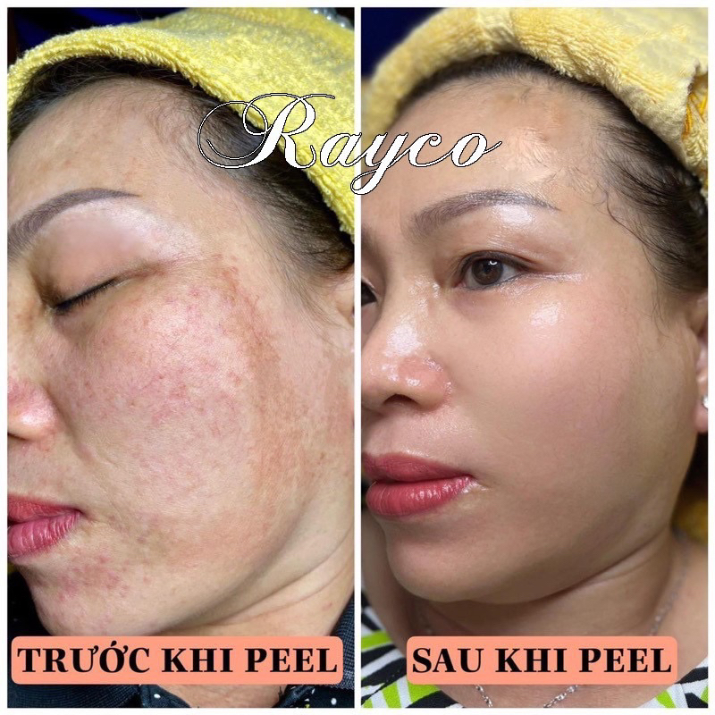 Peel Nám RAYCO Cao Cấp