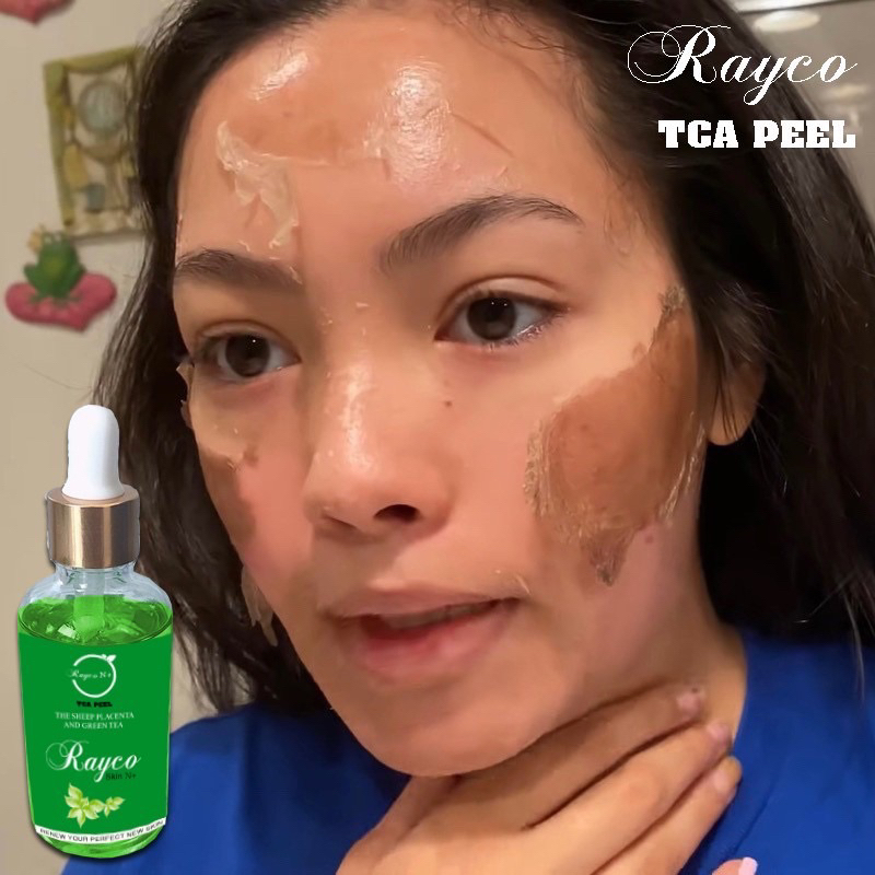 Peel Nám RAYCO Cao Cấp