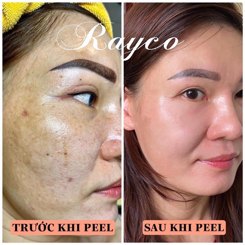 Peel Nám RAYCO Cao Cấp