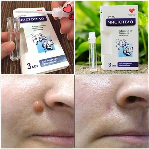 Gel tẩy nốt ruồi mụn cóc mụn thịt mụn cơm mụn ruồi Dvelinil Nga 3ml