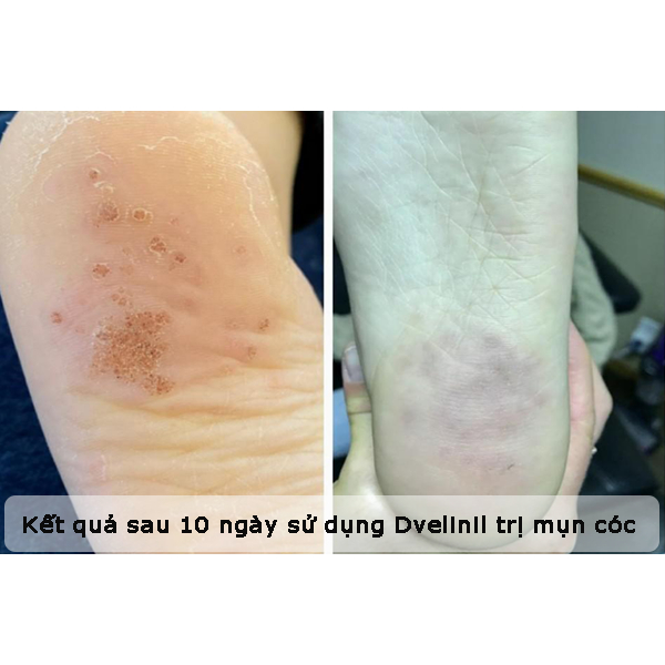 Gel tẩy nốt ruồi mụn cóc mụn thịt mụn cơm mụn ruồi Dvelinil Nga 3ml