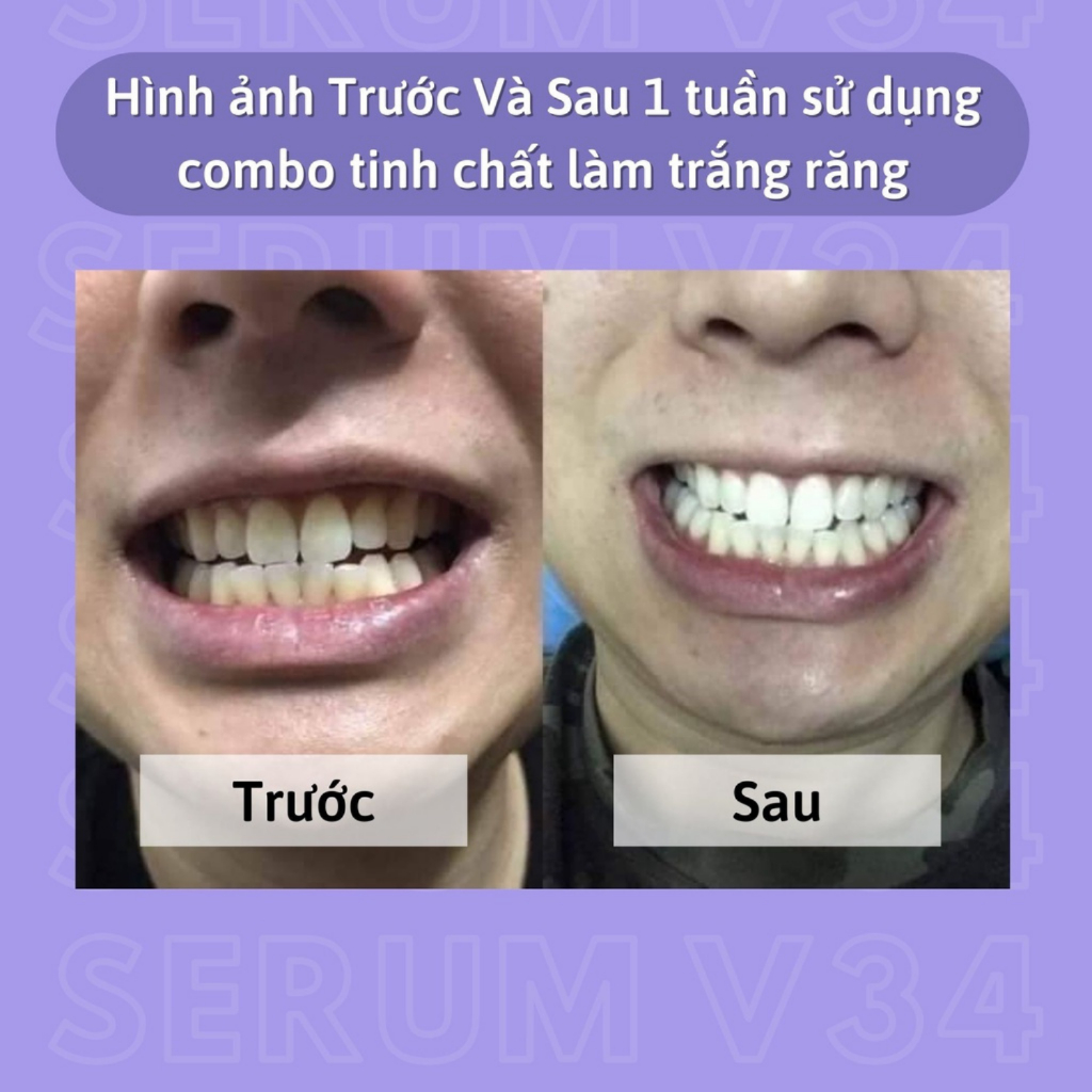 Tinh chất trắng răng SMILEKIT V34, Serum trắng răng giúp trắng răng tự nhiên, an toàn, không gây ê buốt cho răng