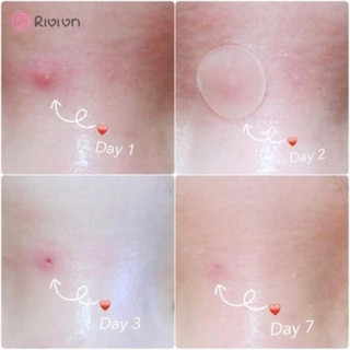 Cosrx miếng dán mụn Acne Pimple Master Patch