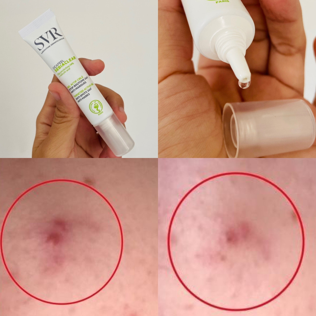 Gel chấm mụn SVR SEBIACLEAR Cicapeel 15ml làm giảm sưng mụn
