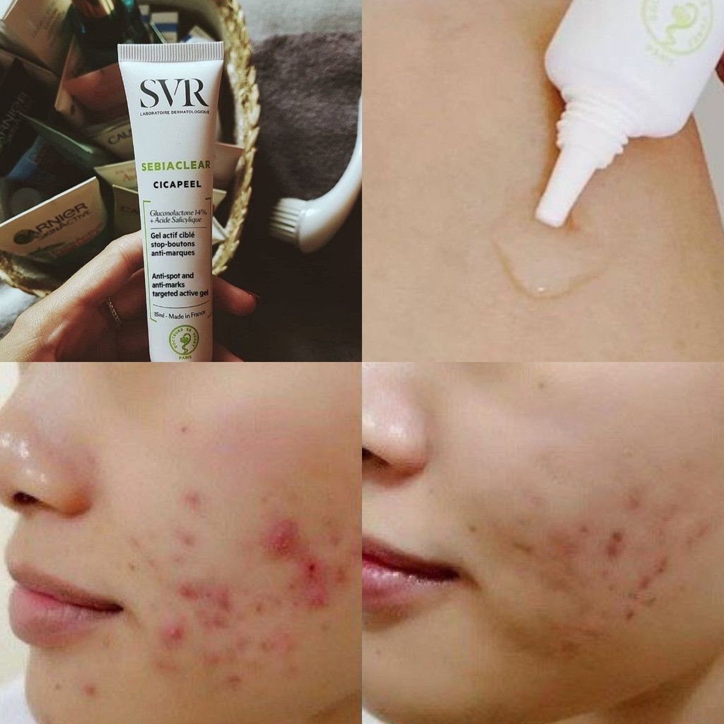 Gel chấm mụn SVR SEBIACLEAR Cicapeel 15ml làm giảm sưng mụn