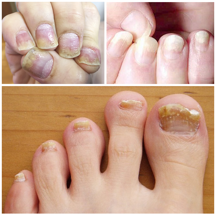 Serum Nấm Móng Tay Chân, Bọng, Hư Khoé Móng, Nước Ăn Tay Chân