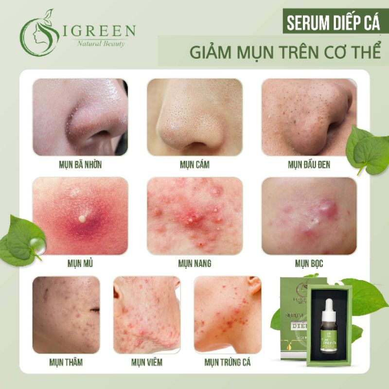 Serum Acne Igreen Diếp Cá chính hãng đánh bay tất cả các loại mụn